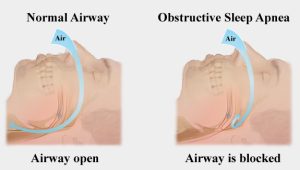 obstructive sleep apnea and normal airway